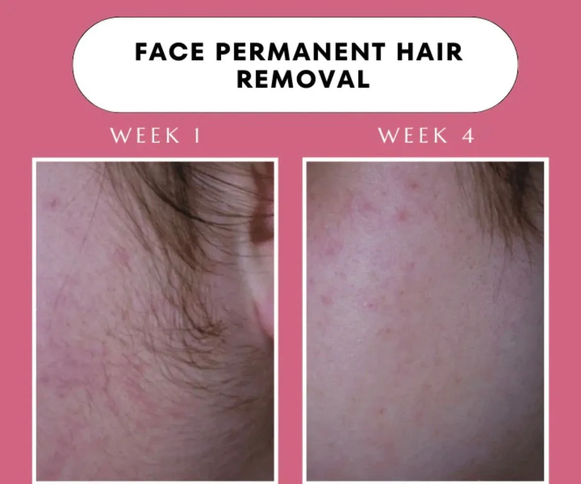 Elitezza IPL Pro - Laser Hair Removal Device